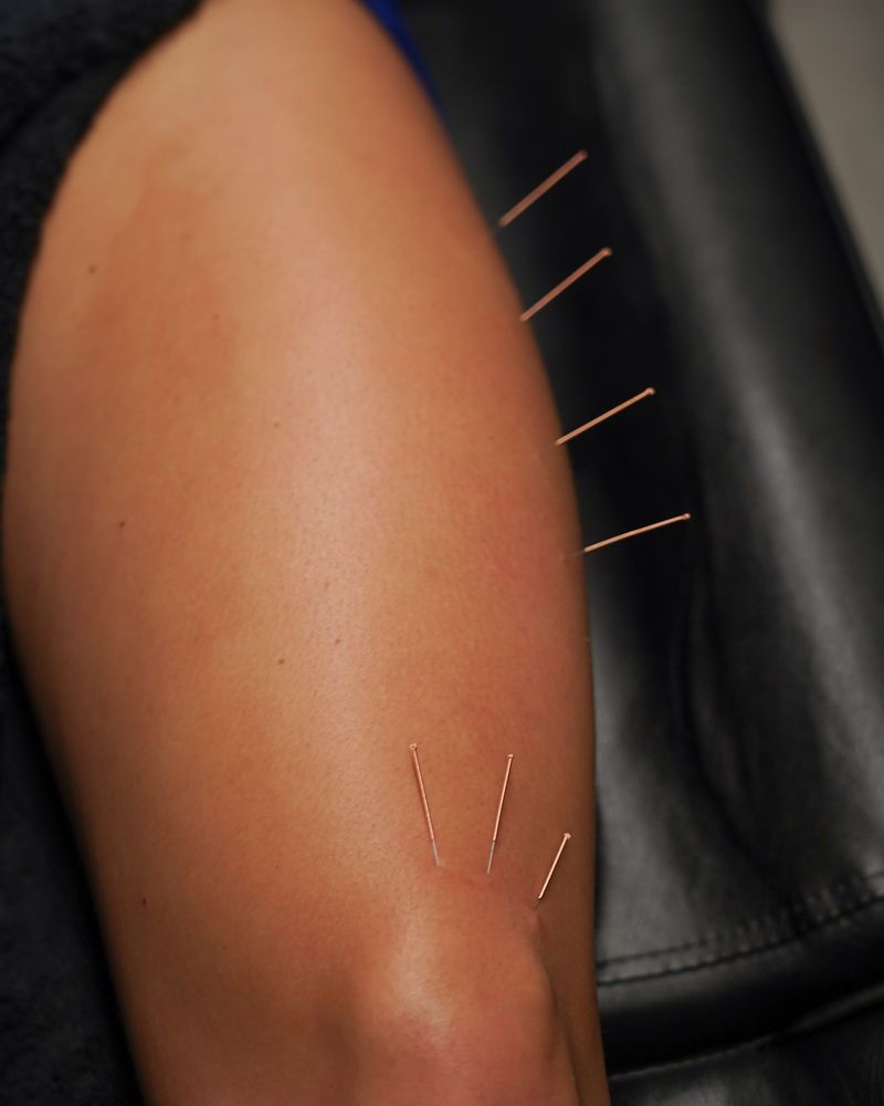 Acupuncture needles in a patient's leg