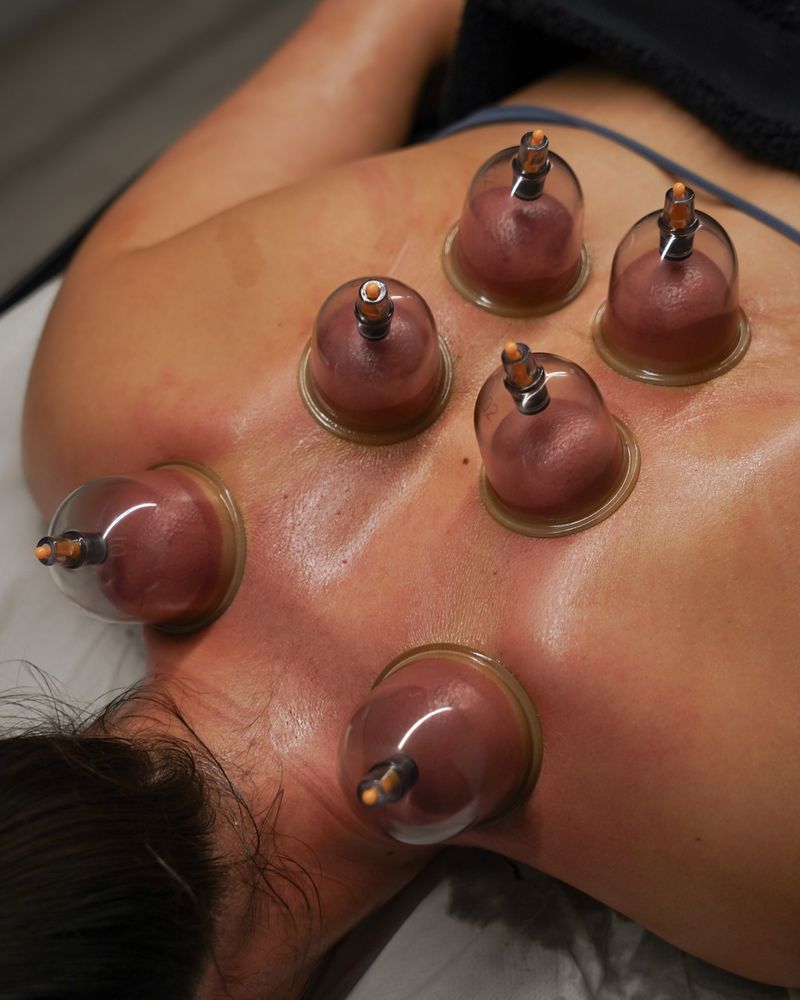 Cupping therapy on a patient's back